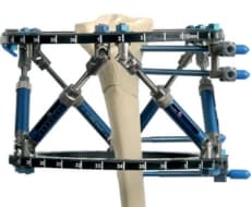 External Fixator
