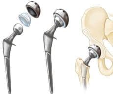 Hip Implants